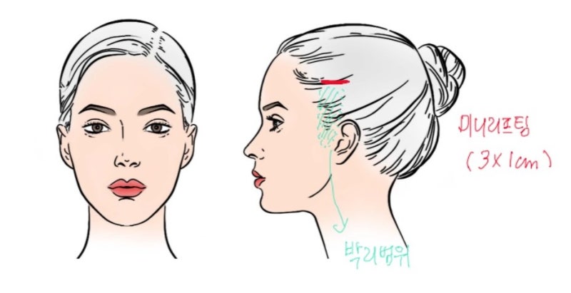 미니거상 절개 범위 및 부위 안내