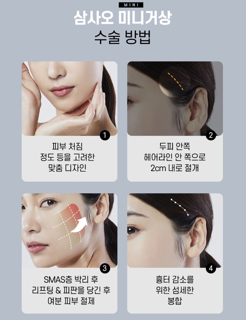 삼사오성형외과 미니거상 수술방법 설명 이미지