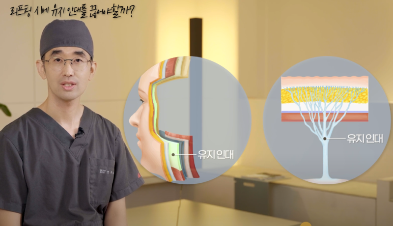 유지인대 박리 질문
