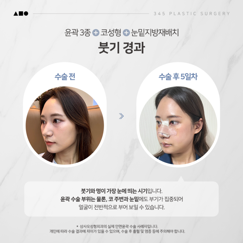 20대 여성 윤곽 3종 + 코성형 + 눈밑지 리얼 붓기 변화 공개