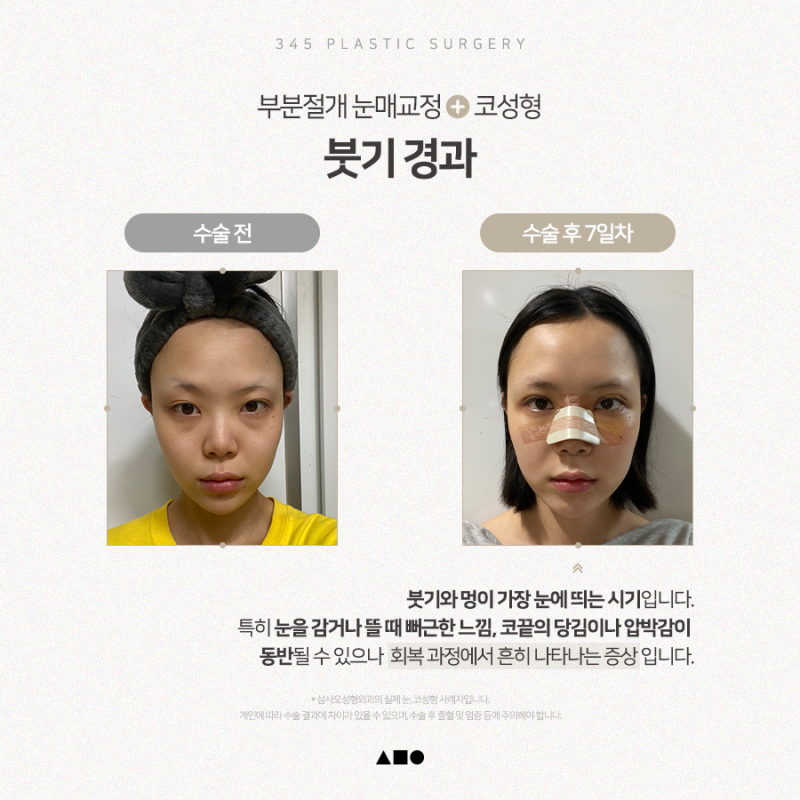 20대 여성 눈+코성형 리얼 붓기 경과