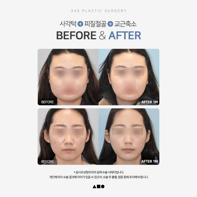 사각턱, 많이 깎는다고 예쁜 턱선이 될까요? 삼사오 긴곡선 사각턱