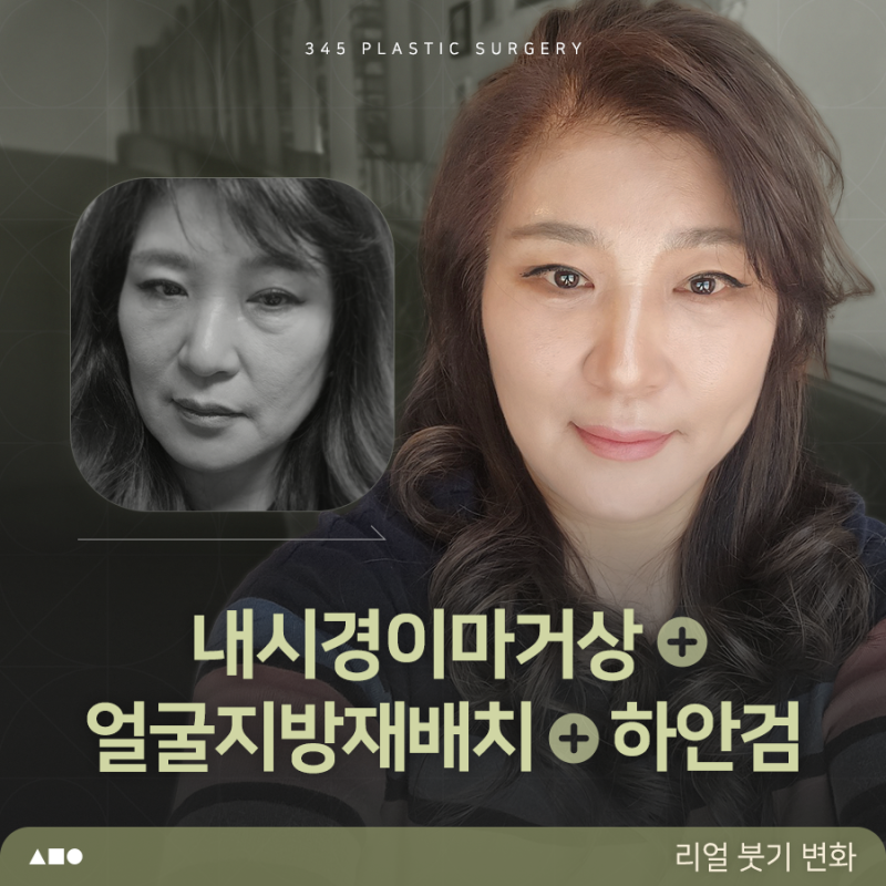 내시경이마거상 붓기, 언제 자연스러워질까요? 실제 회복 과정 공개
