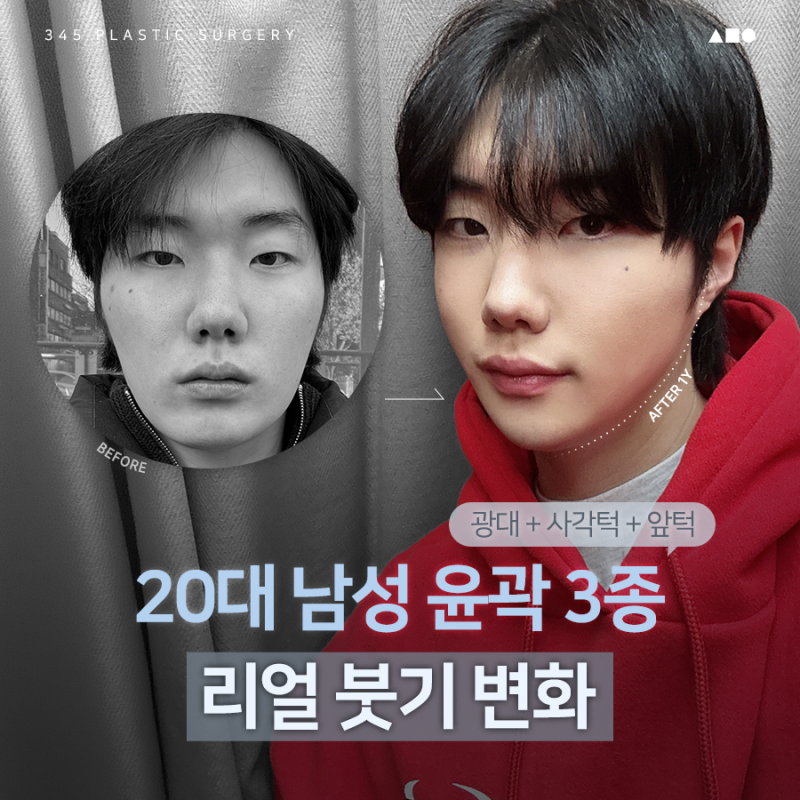 20대 남성 윤곽3종 후기, 붓기 변화 6개월 경과