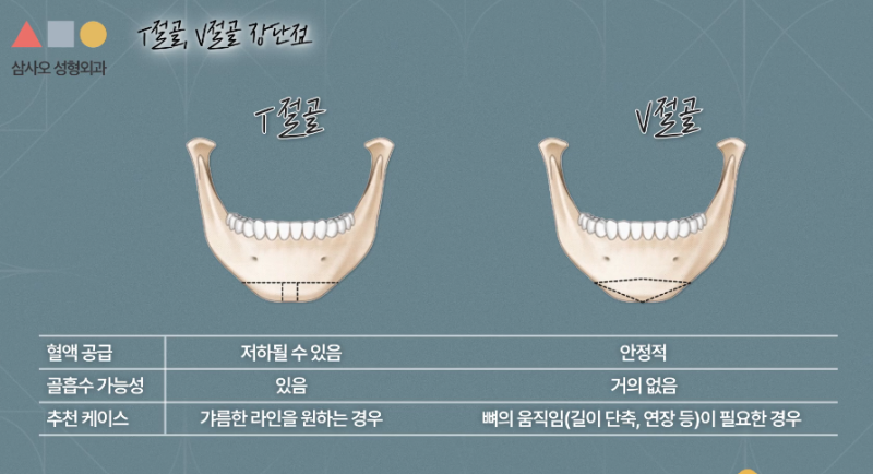 T절골? V절골? 나에게 더 적합한 앞턱수술 방법은?