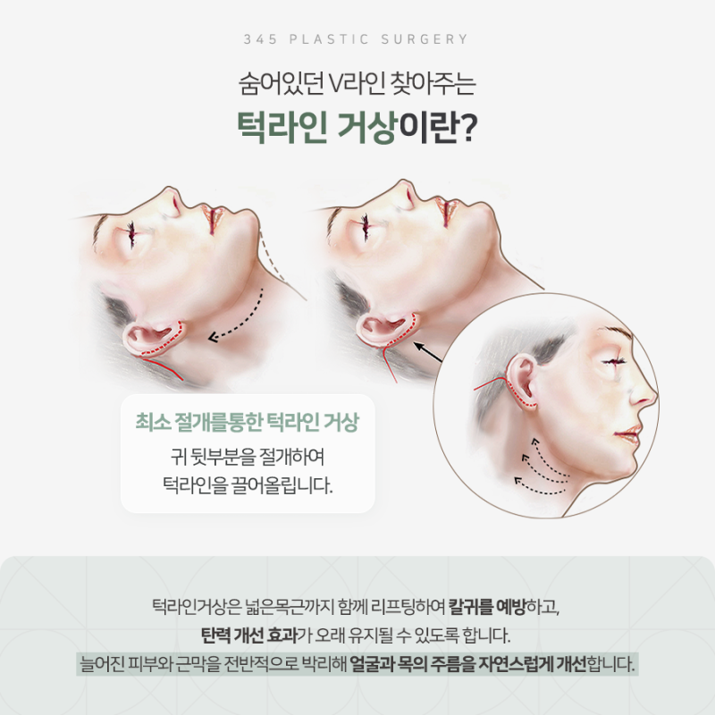 무너진 턱선을 자연스럽게, 턱라인거상 알아보기