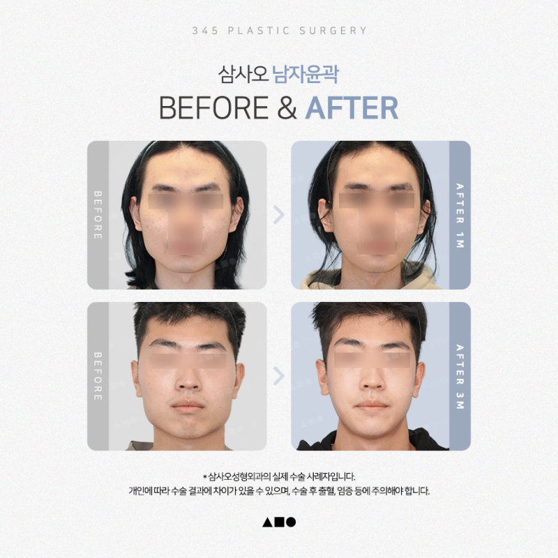 남자 윤곽수술, 자연스러운 얼굴 비율을 만드는 방법