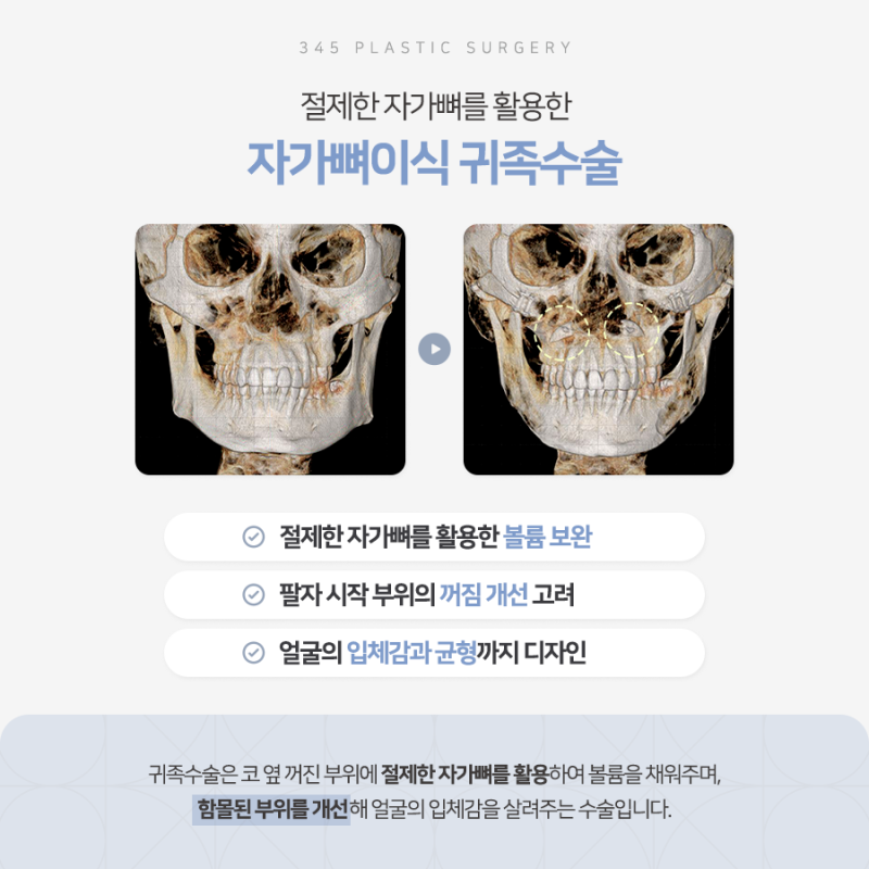 팔자주름 개선을 위한 자가뼈이식 귀족수술