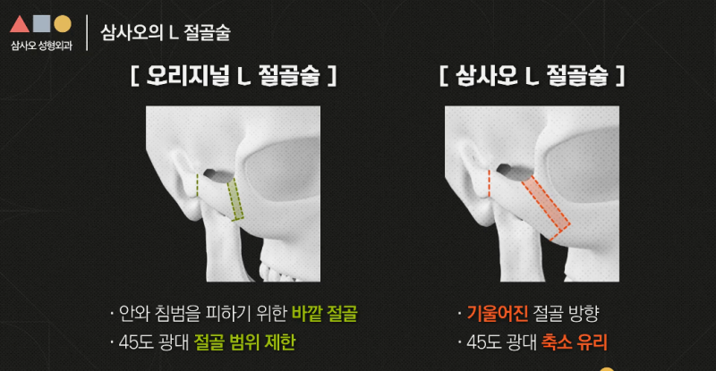 광대축소술, 절골 방식이 결과를 좌우합니다