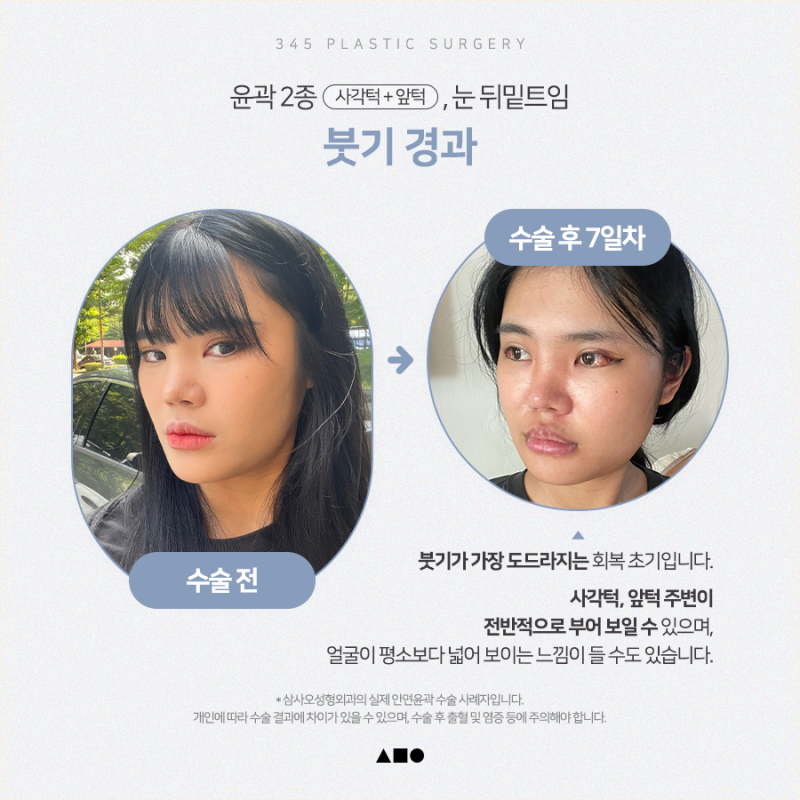 20대 여성 윤곽 2종(사각턱, 앞턱) 리얼 붓기 변화