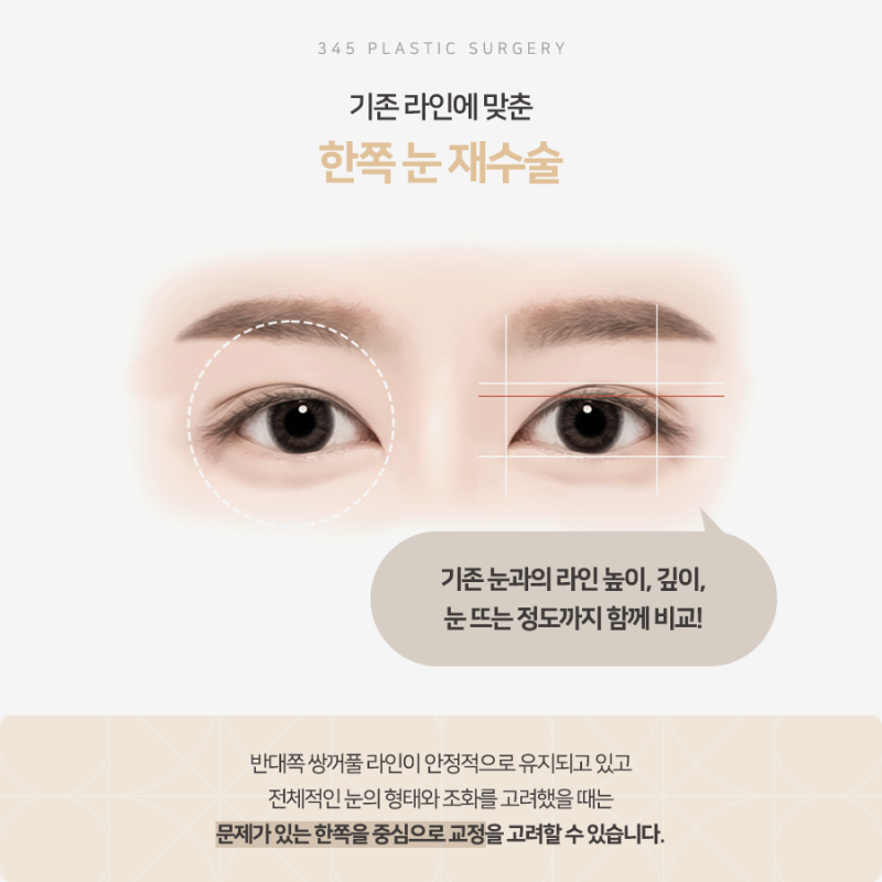 한쪽만 풀린 쌍꺼풀, 짝눈 교정 가능할까요? 사진 4