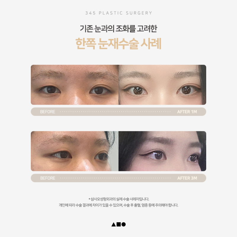 한쪽만 풀린 쌍꺼풀, 짝눈 교정 가능할까요? 사진 6