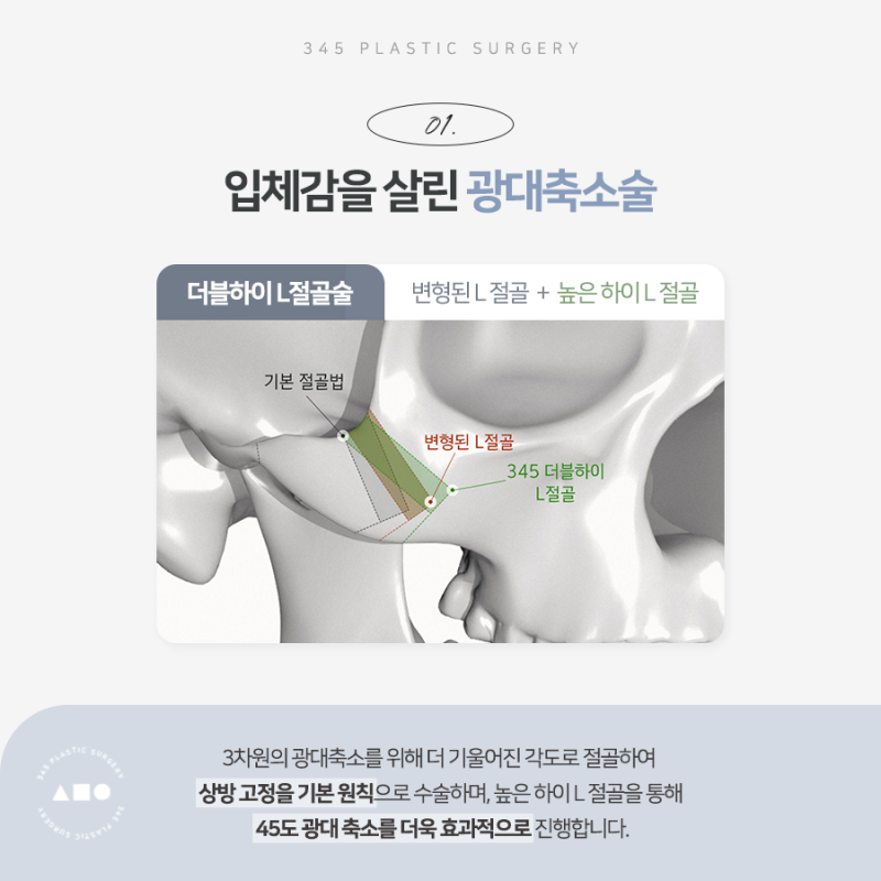 남자 안면윤곽 전후, 얼굴형에 맞는 수술 방법은? 사진 3