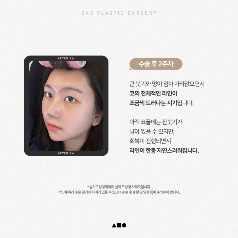 20대 여성 무보형물 연예코 (자가늑) 리얼 붓기 변화 사진 3