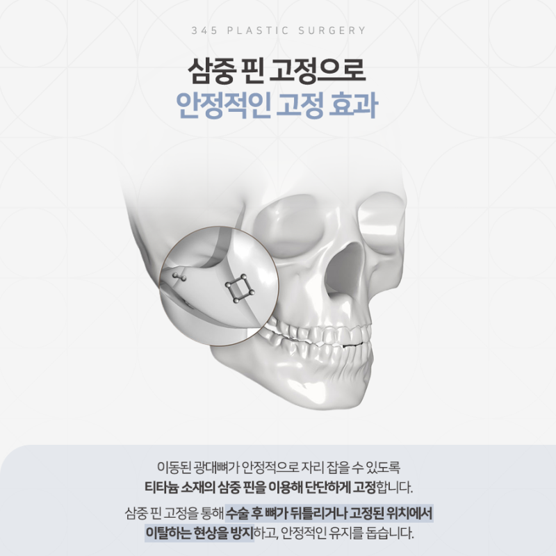 광대축소술 전 알아야 할 3차원 광대 구조와 수술 방법 사진 5