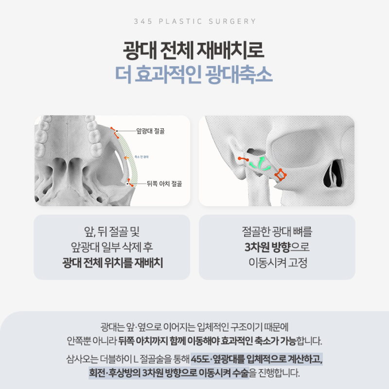 광대축소술 전 알아야 할 3차원 광대 구조와 수술 방법 사진 4