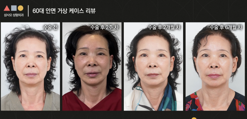 실제 경과로 확인하는 안면거상, 중요한 포인트는? 사진 14