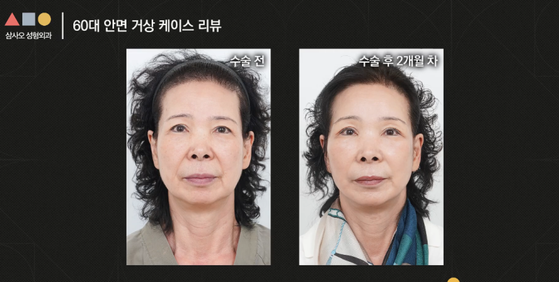실제 경과로 확인하는 안면거상, 중요한 포인트는? 사진 9