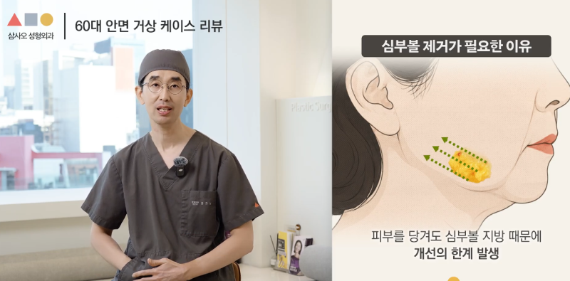 실제 경과로 확인하는 안면거상, 중요한 포인트는? 사진 10