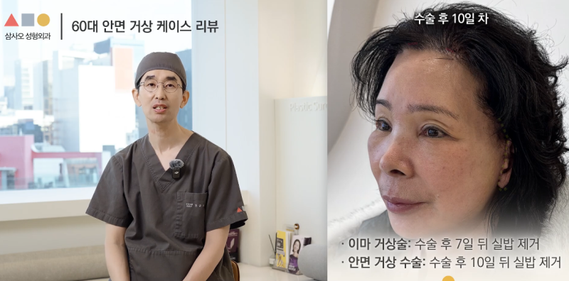 실제 경과로 확인하는 안면거상, 중요한 포인트는? 사진 12