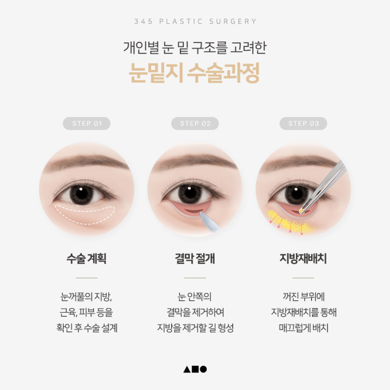 화장으로도 안 가려지는 눈 밑 그늘의 원인은? 삼사오 눈밑지방재배치 사진 4