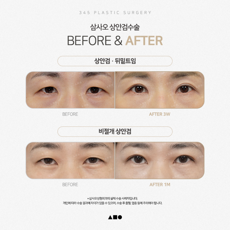 눈꺼풀이 처지고 쌍꺼풀이 덮인다면? 상안검수술 알아보기
