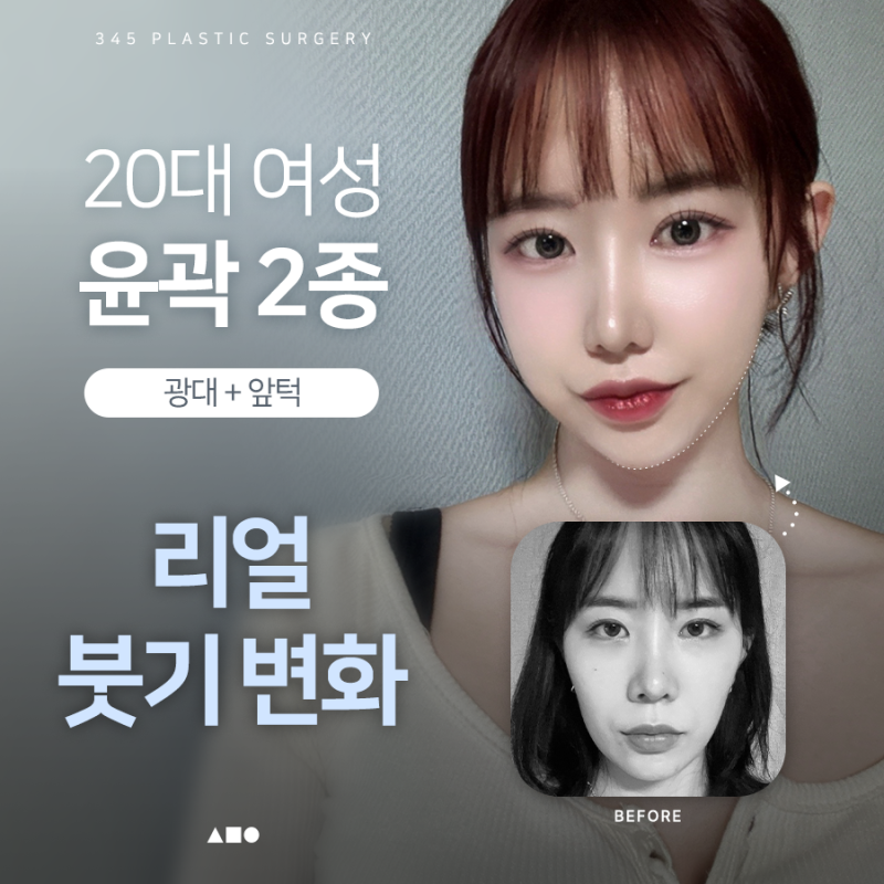 20대 여성 윤곽 2종 (광대, 사각턱) 리얼 붓기 변화