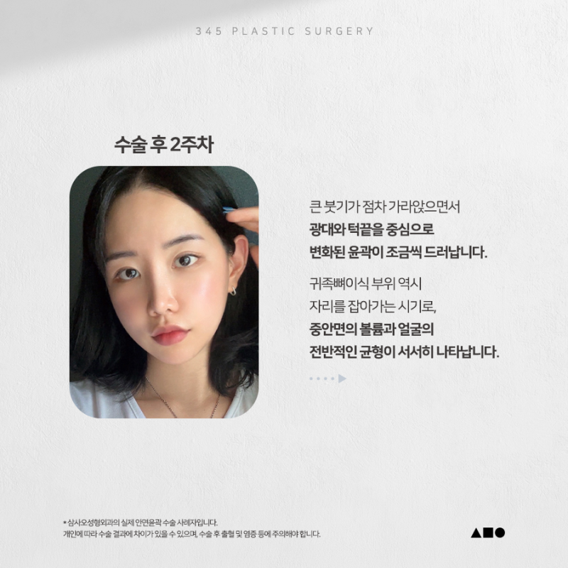 20대 여성 윤곽 2종 (광대, 사각턱) 리얼 붓기 변화 사진 3