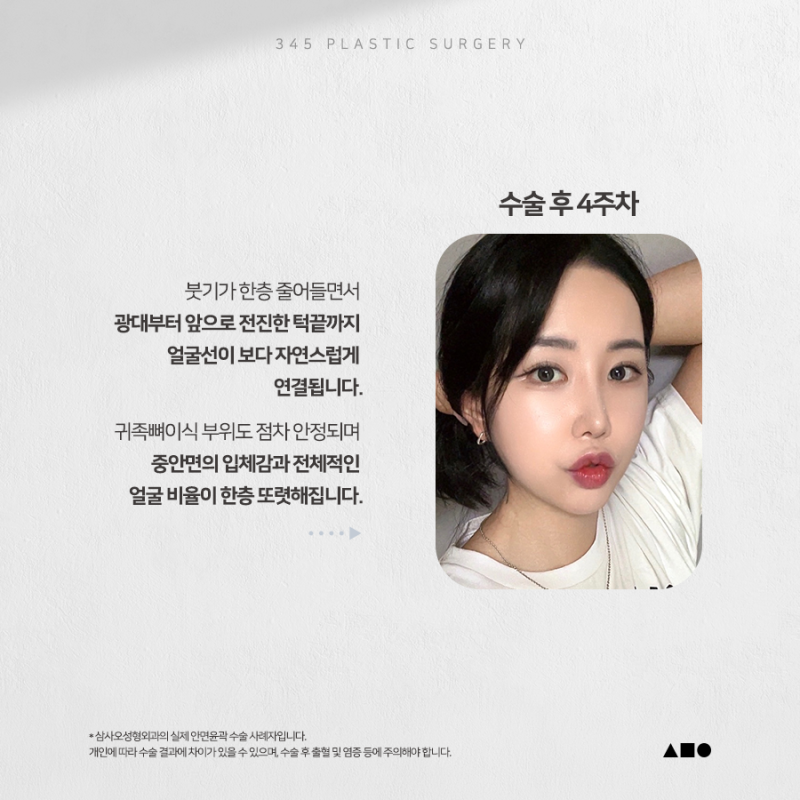 20대 여성 윤곽 2종 (광대, 사각턱) 리얼 붓기 변화 사진 4