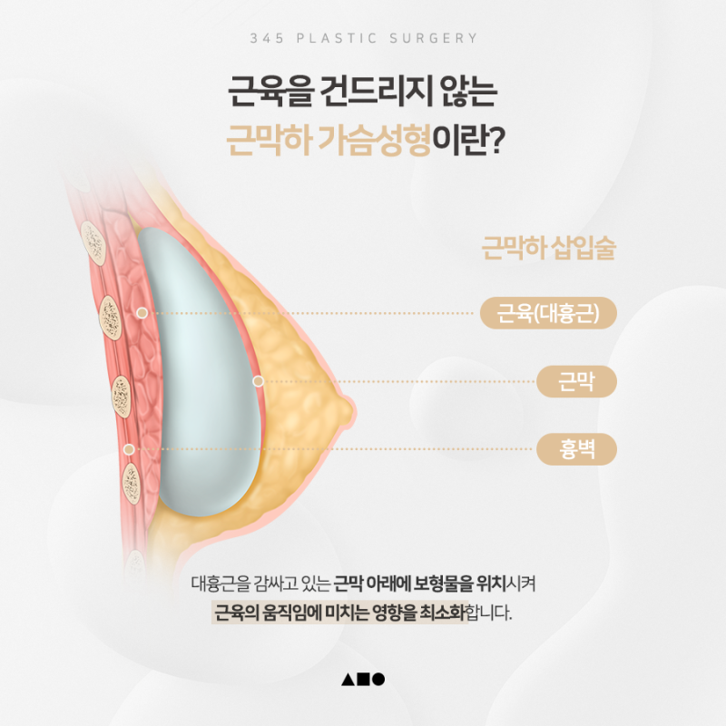 운동하는 나에게 맞춘 가슴성형, 삼사오 근막하 가슴성형 사진 3
