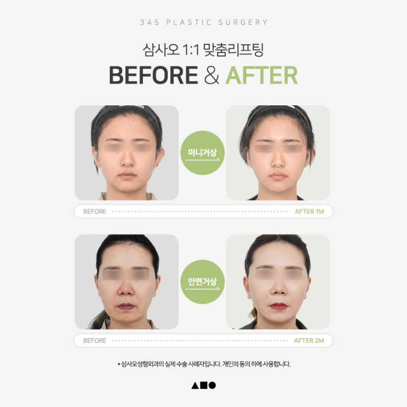 Mini Facelift vs. Minimal Incision Facelift vs. Full Facelift: Differences and Ideal Candidates 사진 2