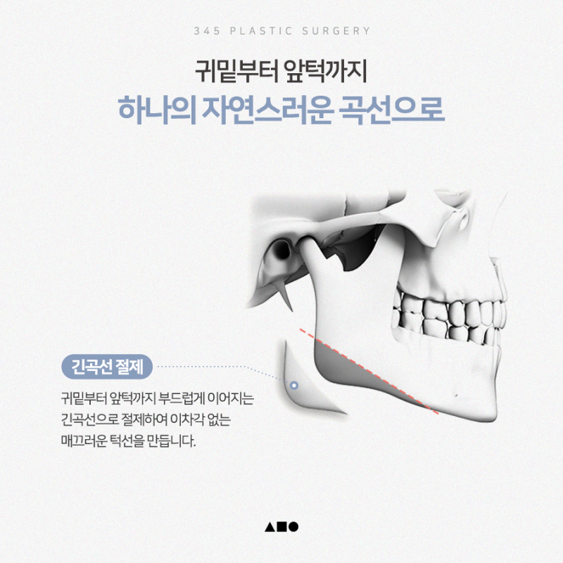 남자 사각턱수술, 갸름하기보다 자연스러운 턱선이 중요한 이유 사진 3