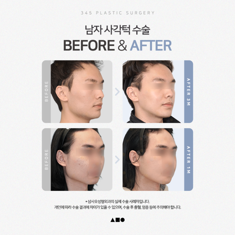 남자 사각턱수술, 갸름하기보다 자연스러운 턱선이 중요한 이유 사진 6