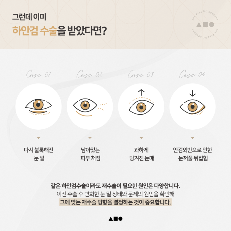 하안검수술, 재수술이라면 더 꼼꼼하게 살펴봐야 하는 이유 사진 4
