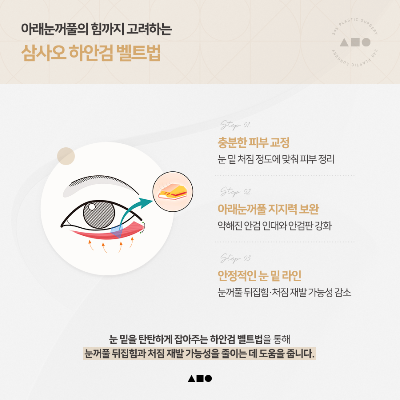 하안검수술, 재수술이라면 더 꼼꼼하게 살펴봐야 하는 이유 사진 5