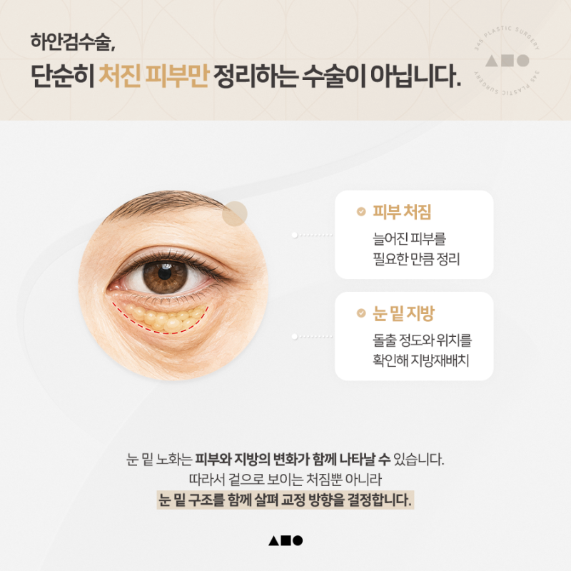 하안검수술, 재수술이라면 더 꼼꼼하게 살펴봐야 하는 이유 사진 3