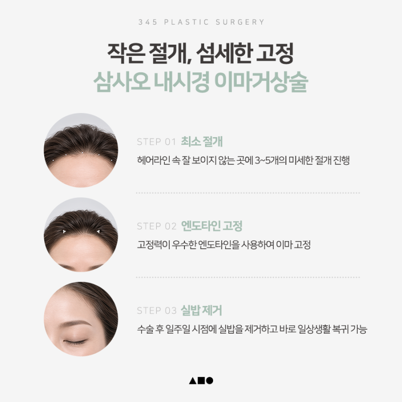 처진 눈썹과 무거워진 눈매, 어떤 수술이 필요할까요? 사진 5