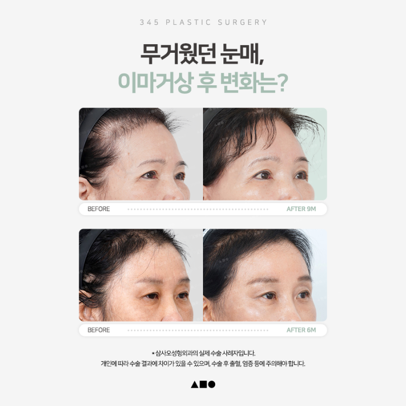 처진 눈썹과 무거워진 눈매, 어떤 수술이 필요할까요? 사진 6
