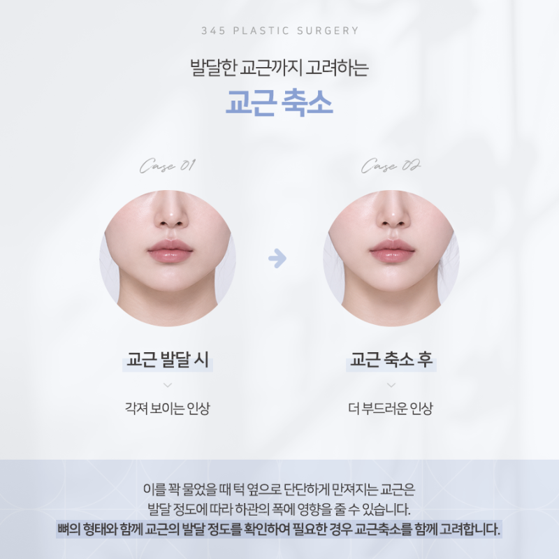 사각턱 수술, 뼈만 줄이면 될까요? 피질절골, 교근축소, 협부지방제거 사진 5