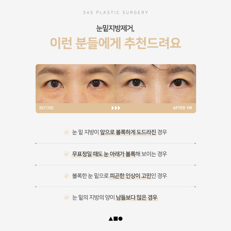 볼록한 눈 밑 지방, 어떻게 줄일 수 있을까요? 사진 6